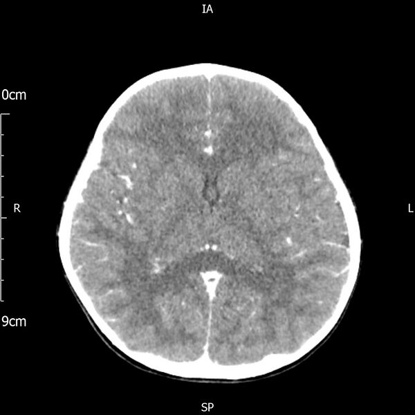 File:Cavernous sinus thrombosis (Radiopaedia 79414-92510 Axial Brain 110).jpg