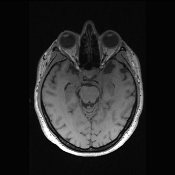 File:Central base of skull meningioma (Radiopaedia 53531-59549 Axial T1 20).jpg