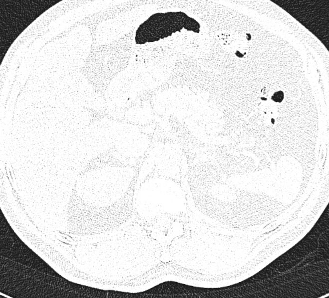 File:Centrilobular pulmonary emphysema (Radiopaedia 26808-26971 Axial lung window 41).jpg