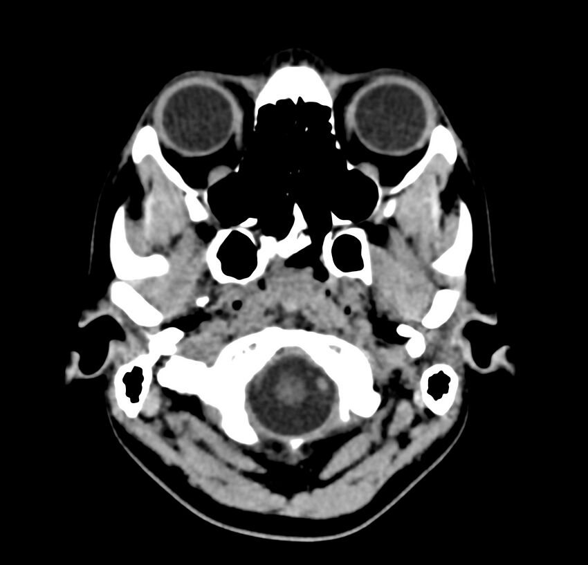 Cerebellar agenesis (Radiopaedia 30203-30817 Axial non-contrast 2).jpg