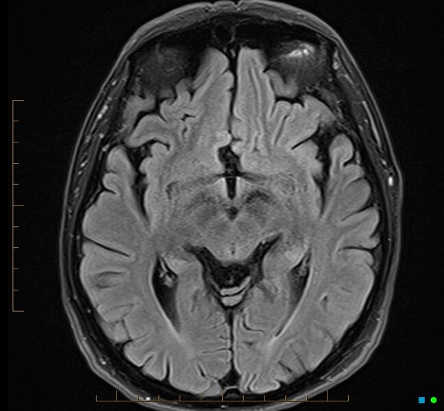 File:Cerebellar gangliocytoma (Radiopaedia 65377-74422 Axial FLAIR 17).jpg