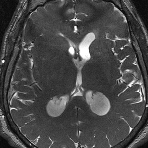 File:Cerebellopontine angle meningioma (Radiopaedia 24459-24764 I 59).jpg