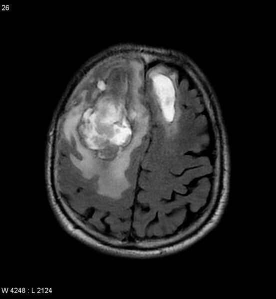 File:Cerebral abscesses secondary to contusions (Radiopaedia 5201-6968 Axial FLAIR 5).jpg