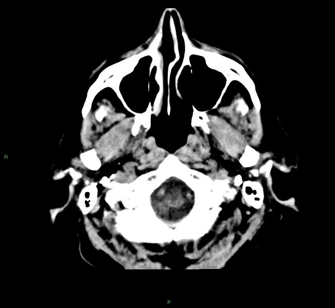 File:Cerebral amyloid angiopathy-associated lobar intracerebral hemorrhage (Radiopaedia 58376-65511 Axial non-contrast 51).jpg