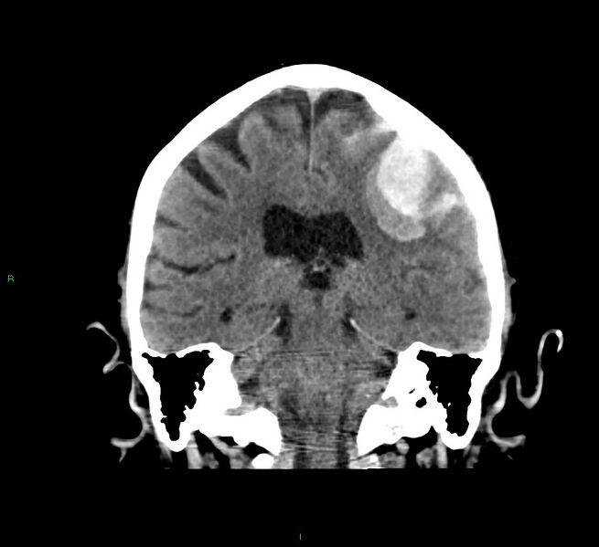 File:Cerebral amyloid angiopathy-associated lobar intracerebral hemorrhage (Radiopaedia 58376-65511 Coronal non-contrast 29).jpg
