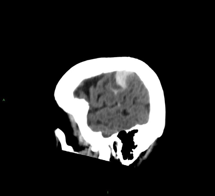 Cerebral amyloid angiopathy-associated lobar intracerebral hemorrhage (Radiopaedia 58376-65513 C 19).jpg