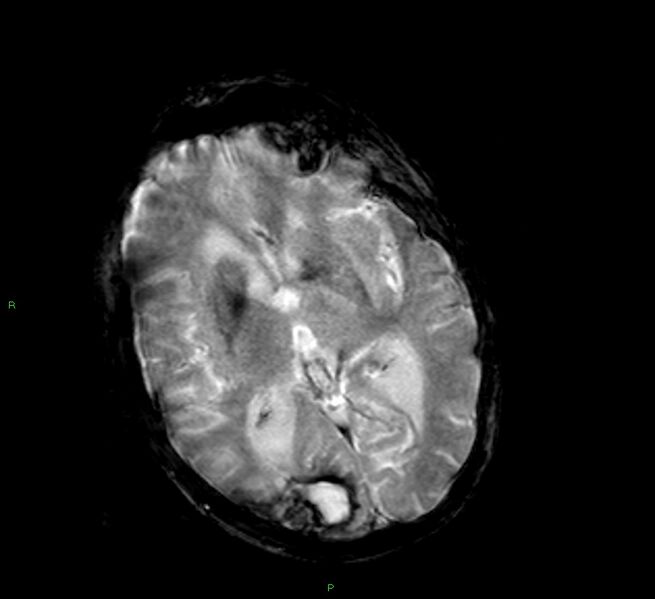 File:Cerebral amyloid angiopathy-associated lobar intracerebral hemorrhage (Radiopaedia 58377-65515 Axial Gradient Echo 14).jpg