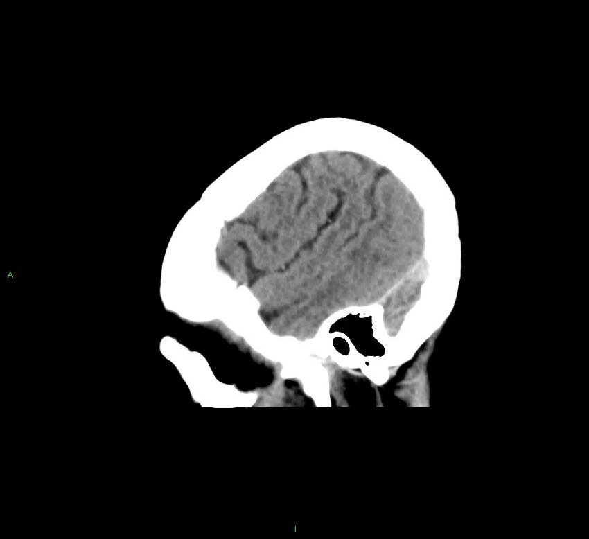 Cerebral amyloid angiopathy-associated lobar intracerebral hemorrhage (Radiopaedia 58378-65516 C 43).jpg