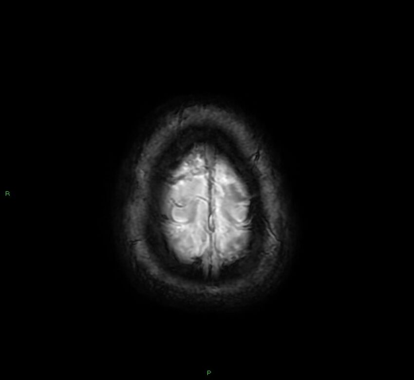 Cerebral amyloid angiopathy-associated lobar intracerebral hemorrhage (Radiopaedia 58378-65517 Axial SWI 69).jpg