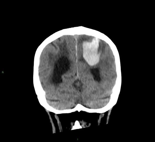 File:Cerebral amyloid angiopathy-associated lobar intracerebral hemorrhage (Radiopaedia 58530-65688 Coronal non-contrast 20).jpg