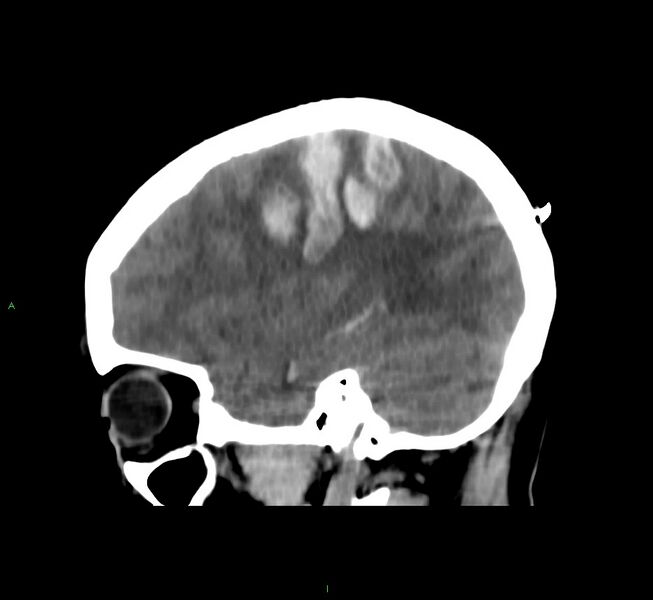 File:Cerebral amyloid angiopathy-associated lobar intracerebral hemorrhage (Radiopaedia 58566-65730 C 15).jpg