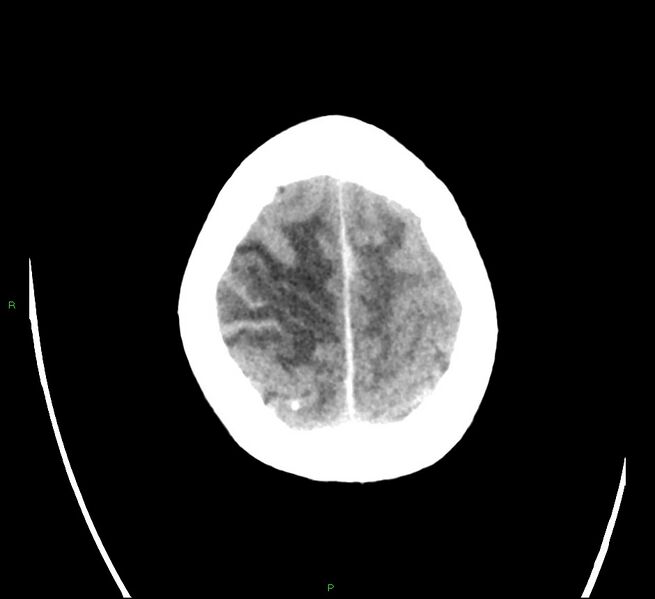 File:Cerebral amyloid angiopathy-associated lobar intracerebral hemorrhage (Radiopaedia 58566-65731 Axial non-contrast 23).jpg