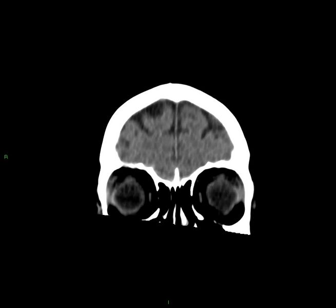File:Cerebral amyloid angiopathy-associated lobar intracerebral hemorrhage (Radiopaedia 58757-65978 Coronal non-contrast 57).jpg