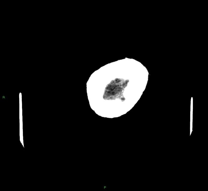 Cerebral amyloid angiopathy-associated lobar intracerebral hemorrhage (Radiopaedia 58757-65979 Axial non-contrast 141).jpg