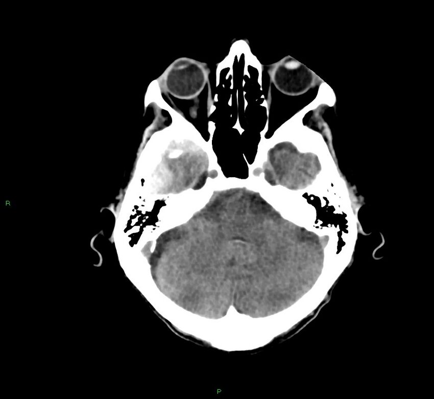 Cerebral amyloid angiopathy-associated lobar intracerebral hemorrhage (Radiopaedia 58758-65980 Axial non-contrast 38).jpg