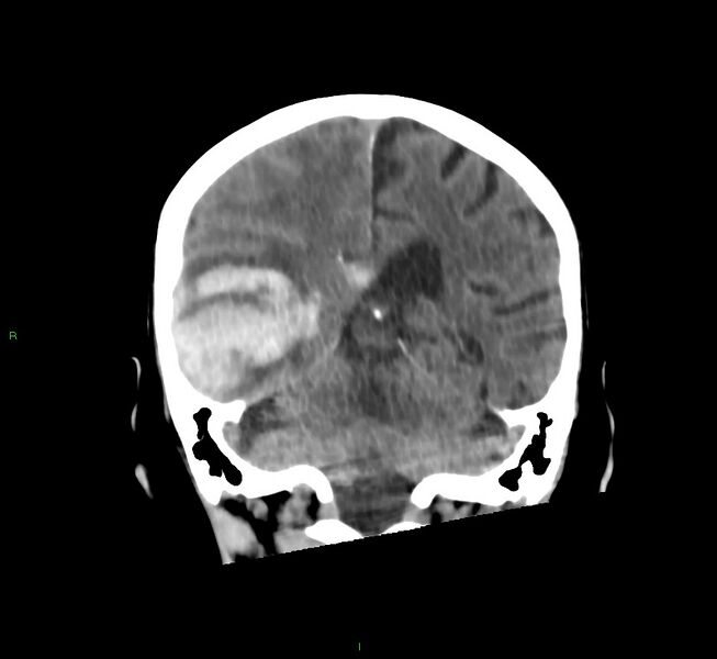 File:Cerebral amyloid angiopathy-associated lobar intracerebral hemorrhage (Radiopaedia 58758-65980 Coronal non-contrast 26).jpg