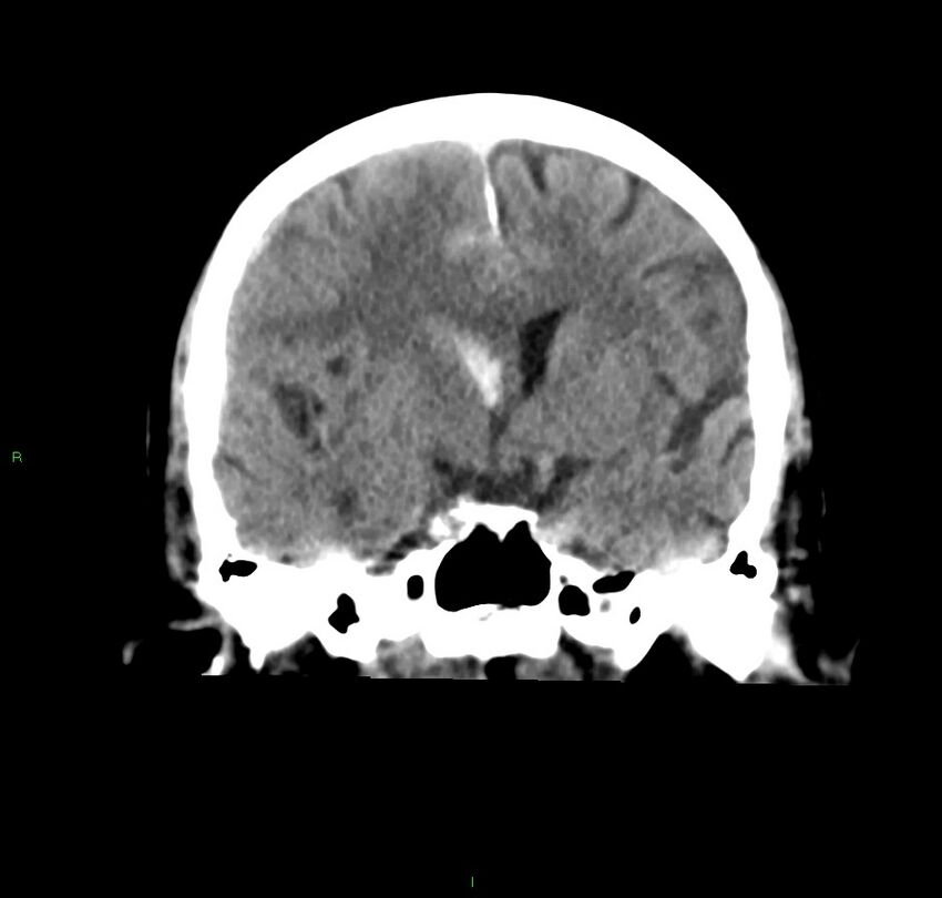 Cerebral amyloid angiopathy-associated lobar intracerebral hemorrhage (Radiopaedia 59356-66716 Coronal non-contrast 38).jpg