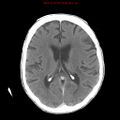 Cerebral and orbital tuberculomas (Radiopaedia 13308-13310 B 17).jpg