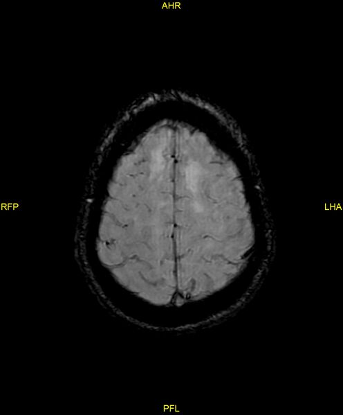 File:Cerebral autosomal dominant arteriopathy with subcortical infarcts and leukoencephalopathy (CADASIL) (Radiopaedia 86108-102054 Axial SWI 89).jpg
