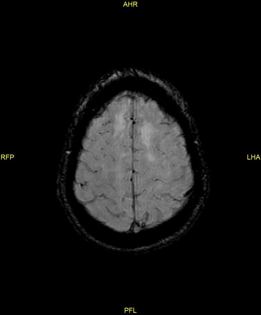 Cerebral autosomal dominant arteriopathy with subcortical infarcts and leukoencephalopathy (CADASIL) (Radiopaedia 86108-102054 Axial SWI 89).jpg