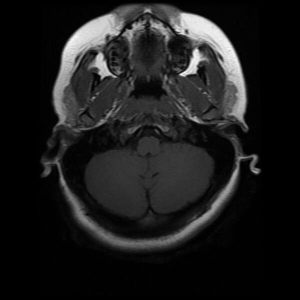 File:Cerebral cavernous malformation (Radiopaedia 44301-47942 Axial T1 4).jpg