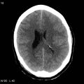 Cerebral hemorrhagic contusion with subdural and subarachnoid hemorrhage (Radiopaedia 10680-19197 Axial non-contrast 14).jpg