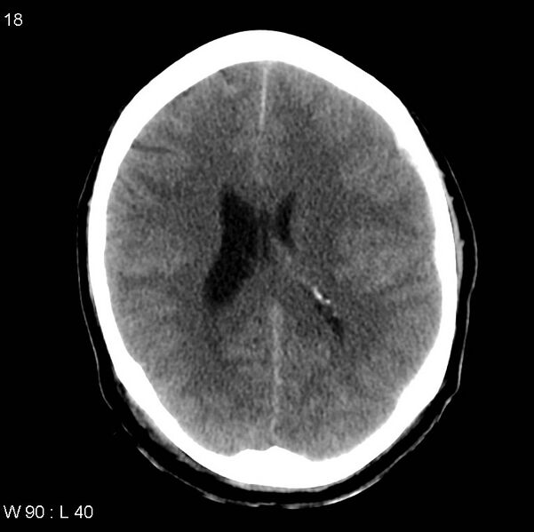 File:Cerebral hemorrhagic contusion with subdural and subarachnoid hemorrhage (Radiopaedia 10680-19197 Axial non-contrast 14).jpg