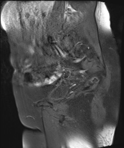 File:Cervical carcinoma (Radiopaedia 88312-104943 Sagittal T1 fat sat 11).jpg