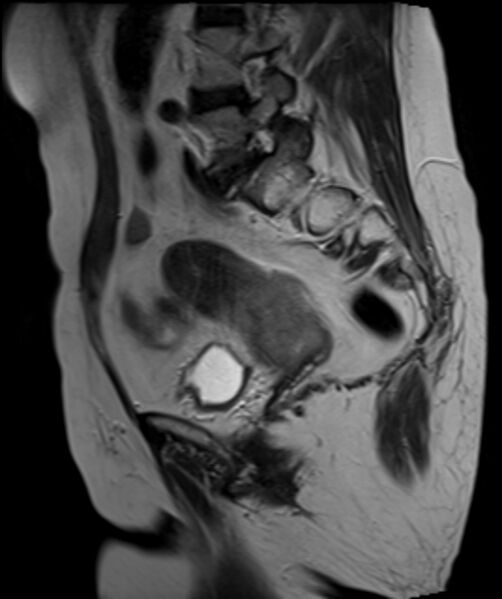 File:Cervical carcinoma (Radiopaedia 88312-104943 Sagittal T2 19).jpg