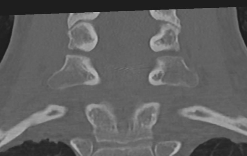 File:Cervical disc replacement (Radiopaedia 37383-39205 Coronal bone window 38).png