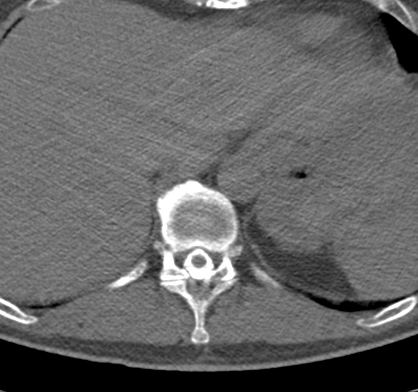 Cervical dural CSF leak on MRI and CT treated by blood patch (Radiopaedia 49748-54996 B 77).png