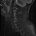 Cervical flexion teardrop fracture with cord hemorrhage (Radiopaedia 32497-33455 Sagittal STIR 16).jpg