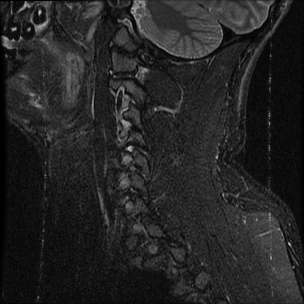 File:Cervical flexion teardrop fracture with cord hemorrhage (Radiopaedia 32497-33455 Sagittal STIR 16).jpg