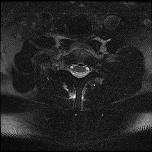 File:Cervical fracture and dislocation with locked facet (Radiopaedia 31837-32781 Axial T2 fat sat 10).jpg