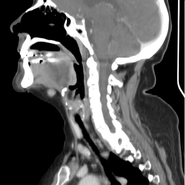 File:Cervical lymphadenopathy- cause unknown (Radiopaedia 22420-22457 D 18).jpg