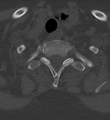Cervical spine ACDF loosening (Radiopaedia 48998-54070 Axial bone window 53).png