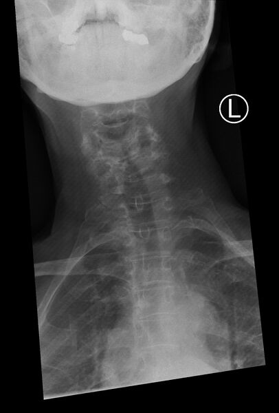 File:Cervical spine dynamic instability in patient with rheumatoid arthritis (Radiopaedia 45107-49087 Frontal 1).jpg