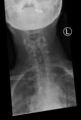 Cervical spine dynamic instability in patient with rheumatoid arthritis (Radiopaedia 45107-49087 Frontal 1).jpg
