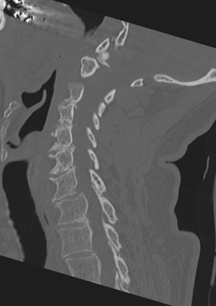File:Cervical spine fractures with vertebral artery dissection (Radiopaedia 53296-59268 Sagittal bone window 28).png