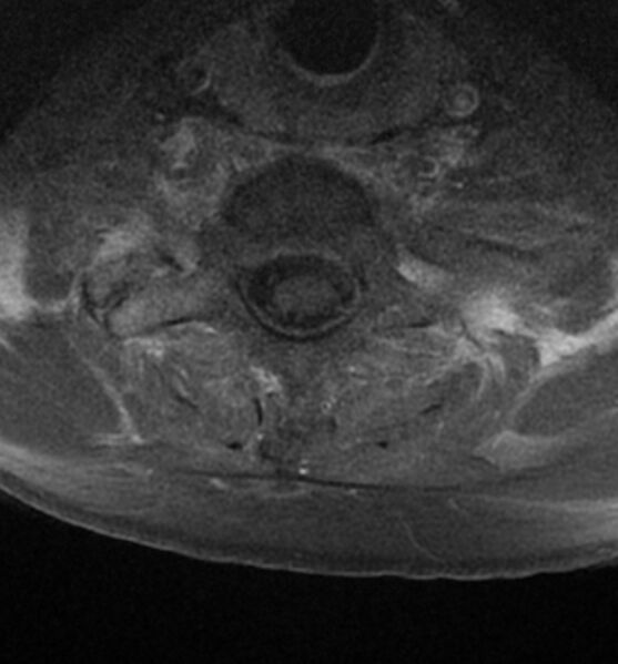 File:Cervical spondylodiscitis (Radiopaedia 81362-95110 Axial T1 C+ fat sat 16).jpg