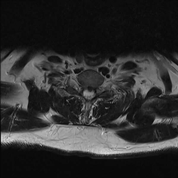 File:Cervical tumor-like myelopathy due to Type V dAVF (Radiopaedia 82461-96604 Axial T2 30).jpg