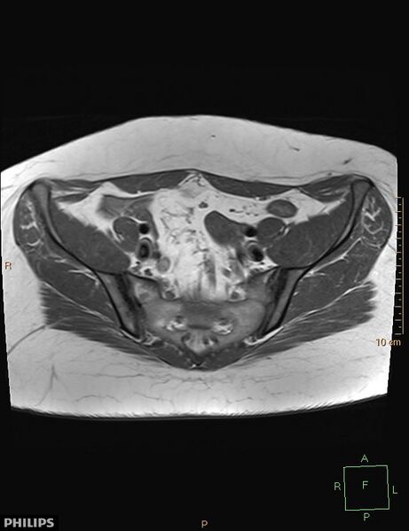 File:Cesarian scar endometriosis (Radiopaedia 68495-78066 Axial T1 5).jpg