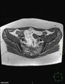 Cesarian scar endometriosis (Radiopaedia 68495-78066 Axial T1 5).jpg