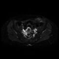 Cesarian section scar endometriosis (Radiopaedia 66520-75799 Axial DWI 8).jpg