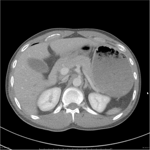 File:Chest and abdomen multi-trauma (Radiopaedia 26294-26426 bone window 26).jpg