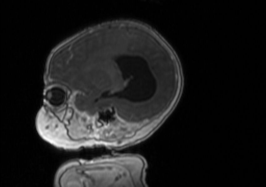 Chiari III malformation with occipital encephalocele (Radiopaedia 79446-92559 Sagittal T1 C+ mpr 48).jpg