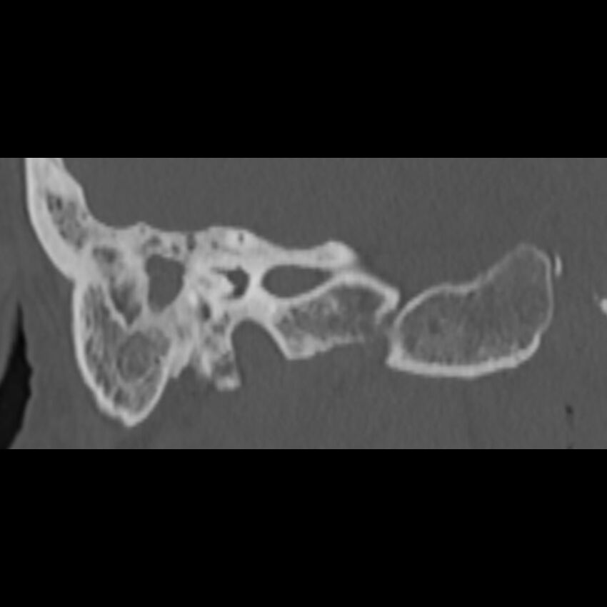 Cholesteatoma (Radiopaedia 68176-77673 Coronal bone window 51).jpg