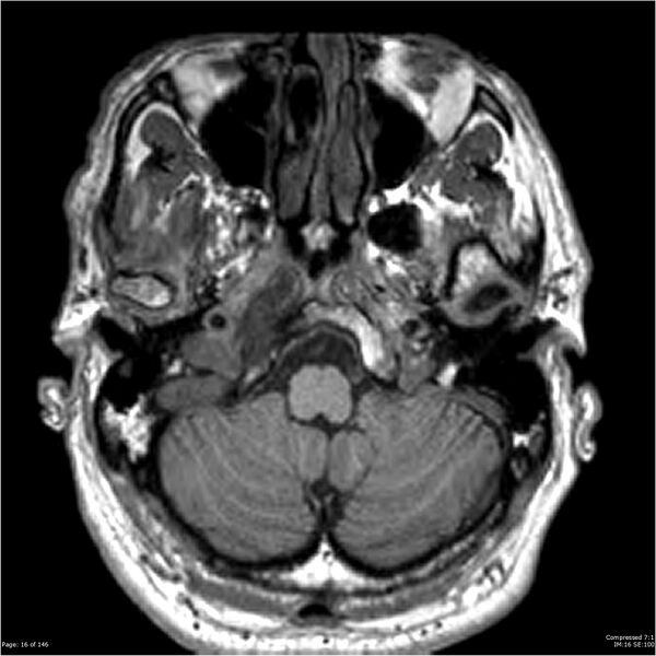 File:Chondrosarcoma of skull base- grade II (Radiopaedia 40948-43654 Axial T1 16).jpg