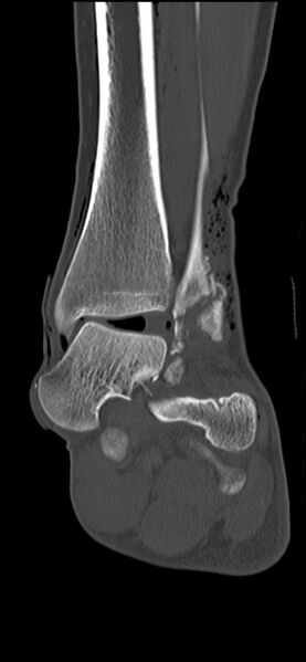 File:Chopart fracture (Radiopaedia 35347-36851 Coronal bone window 35).jpg