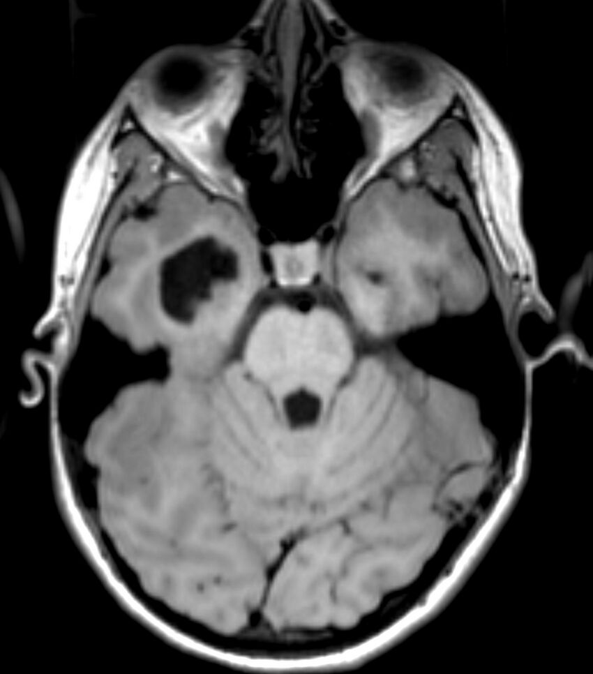 Choroid plexus carcinoma (Radiopaedia 91013-108553 Axial T1 62).jpg